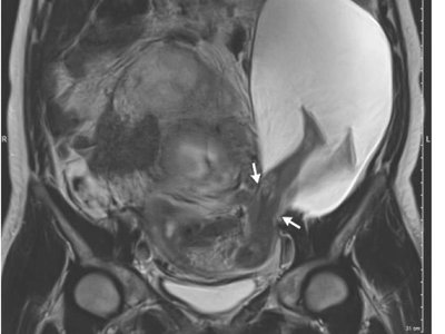 El increíble embarazo de un bebé que atravesó el útero con sus piernas 