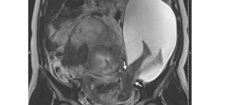 El increíble embarazo de un bebé que atravesó el útero con sus piernas 