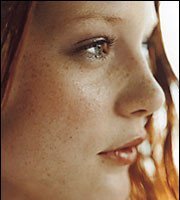 Cloasma: las manchas del embarazo