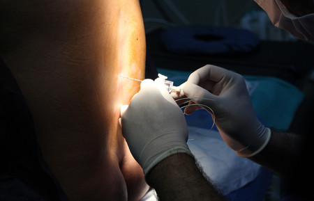 anestesia epidural