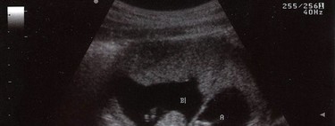 Complicaciones más comunes en el embarazo de gemelos