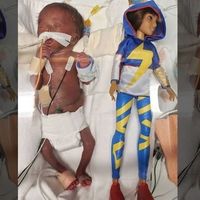 Dan de alta a una bebé prematura que pesó 370 gramos al nacer con casi 25 semanas de gestación