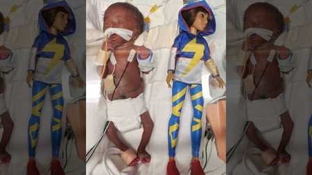 Dan de alta a una bebé prematura que pesó 370 gramos al nacer con casi 25 semanas de gestación