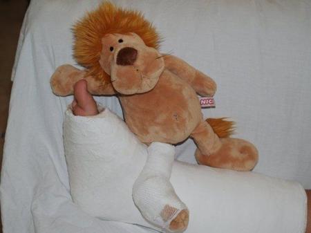 Fracturas de huesos en los niños