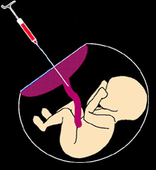 La cordocentesis