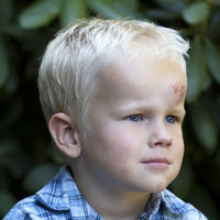 Golpes en la cabeza: qué hacer si el niño se ha golpeado y síntomas de alerta