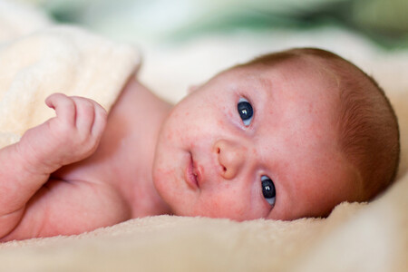 acné neonatal