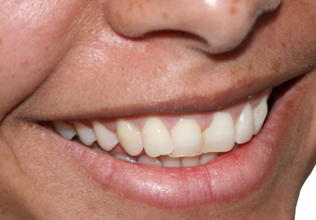 halitosis