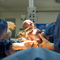 No hay pruebas de que los partos por cesárea causen autismo o TDAH