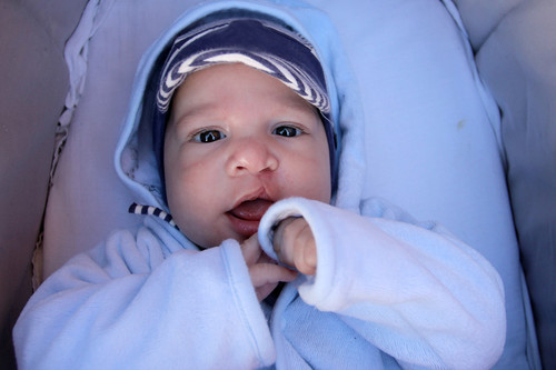 Labio leporino y paladar hendido en el bebé, ¿se puede prevenir?