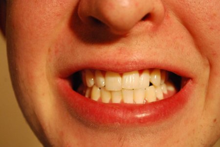 Los alimentos más peligrosos para nuestros dientes