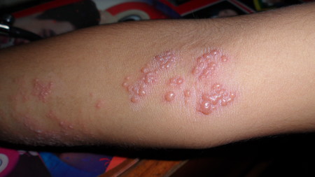 Herpes zóster: qué es, síntomas, complicaciones y tratamiento