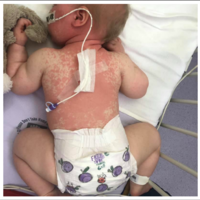 Publica fotos de su bebé enferma de sarampión, para concienciar sobre la importancia de vacunar a los niños