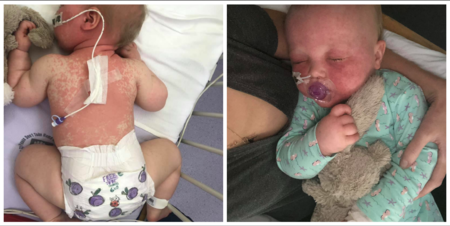 Publica fotos de su bebé enferma de sarampión, para concienciar sobre la importancia de vacunar a los niños