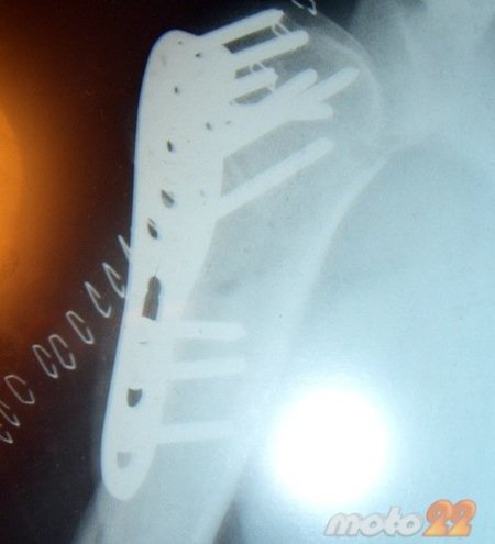 Retirar una placa y sus diez tornillos
