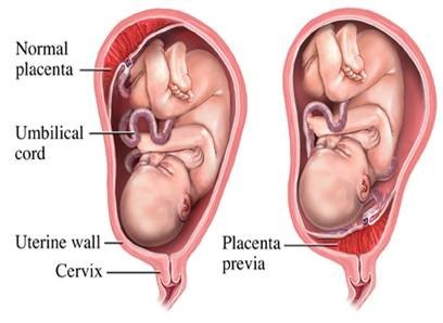 Placenta Previa Que Es