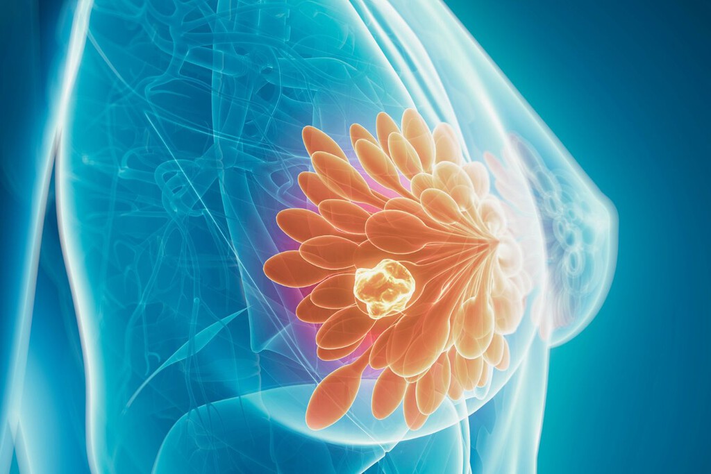 En Argentina testean una IA para detectar cáncer de mama:  cómo se desarrolló MammoInsight, la plataforma que ayudará a tratar 22.000 casos al año 