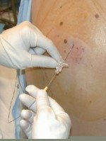 Ventajas y desventajas de la epidural