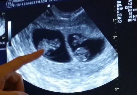 dos-sacos-gestacionales