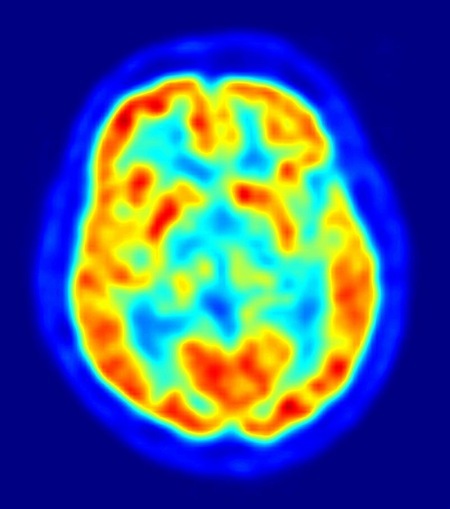 Estudio: En personas anoréxicas, el cerebro responde de manera diferente a la sensación de hambre