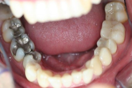 ¿Cómo contaminan tus empastes dentales?