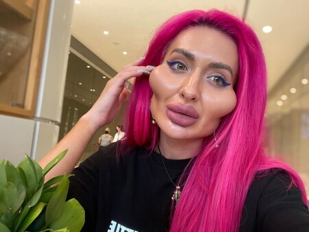 Sí, hay gente más operada que Kiko Matamoros y María Patiño: las fotos de la mujer con pómulos de récord que se ha hecho viral