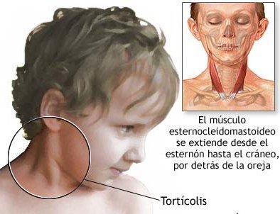torticolis