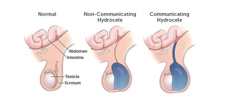 hidrocele