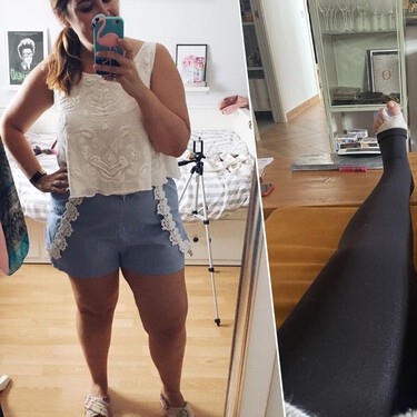 Sufro lipedema desde hace 20 años: esta es mi historia entre dolor crónico, operaciones, culpa y grandes logros