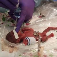 La bebé microprematura más pequeña del mundo, que pesó 245 gramos al nacer, fue dada de alta