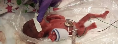 La bebé microprematura más pequeña del mundo, que pesó 245 gramos al nacer, fue dada de alta