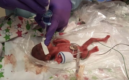 La bebé microprematura más pequeña del mundo, que pesó 245 gramos al nacer, fue dada de alta