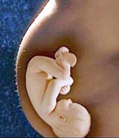 Síndrome alcohólico fetal: 1 de cada 750 bebés cuyas madres consumen alcohol lo padecen