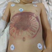 Una madre advierte del riesgo de atrapamiento por succión después de que su hijo fuera succionado por el desagüe de una piscina 