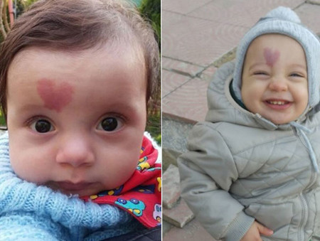 'Love Baby': el bebé que nació con una mancha en forma de corazón en la frente