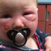 Mucho cuidado con lo que le aplicas a tu bebé: su hija de 14 meses sufre quemaduras en la cara a causa de un spray solar