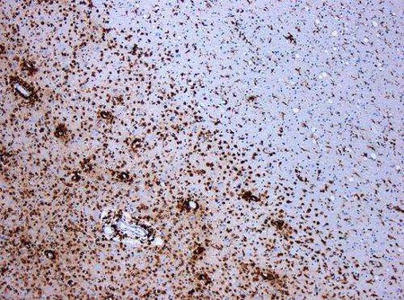 Un estudio gigantesco sugiere que la infección por el virus de Epstein-Barr es necesaria para desarrollar esclerosis múltiple