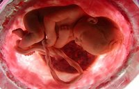 Bacterias en la placenta podrían provocar partos prematuros