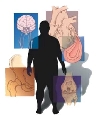 ¿Qué es el Síndrome Metabólico?
