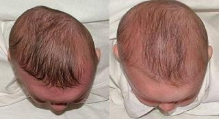 Plagiocefalia, متى نبدأ بتقييم نجاح خوذة علاج الرأس المسطح؟