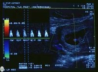La ecografía doppler en el control del embarazo
