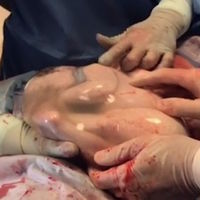 Increíble parto velado de trillizos: uno de los bebés nace dentro de la bolsa amniótica y observan durante siete minutos como está dentro del útero