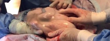 Increíble parto velado de trillizos: uno de los bebés nace dentro de la bolsa amniótica y observan durante siete minutos como está dentro del útero 