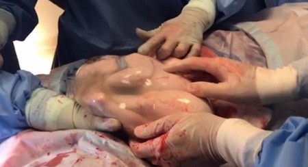 Increíble parto velado de trillizos: uno de los bebés nace dentro de la bolsa amniótica y observan durante siete minutos como está dentro del útero