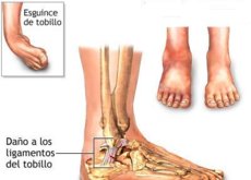 Definicion esguince de tobillo pdf