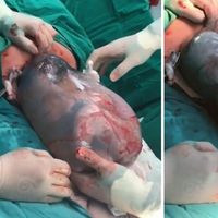Impresionante vídeo viral de un parto velado en el que el bebé nace dentro del saco amniótico, y nada tiene que ver con el Covid