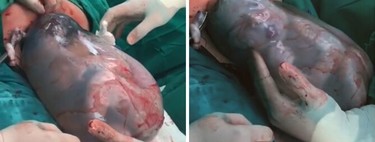 Impresionante vídeo viral de un parto velado en el que el bebé nace dentro del saco amniótico, y nada tiene que ver con el Covid