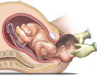 ¿Qué es el parto seco?