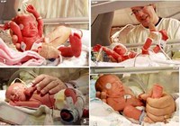 Ahora cuatrillizas idénticas, un caso muy raro