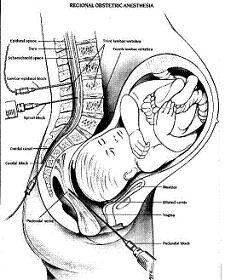 Asocian epidural con problemas de lactancia